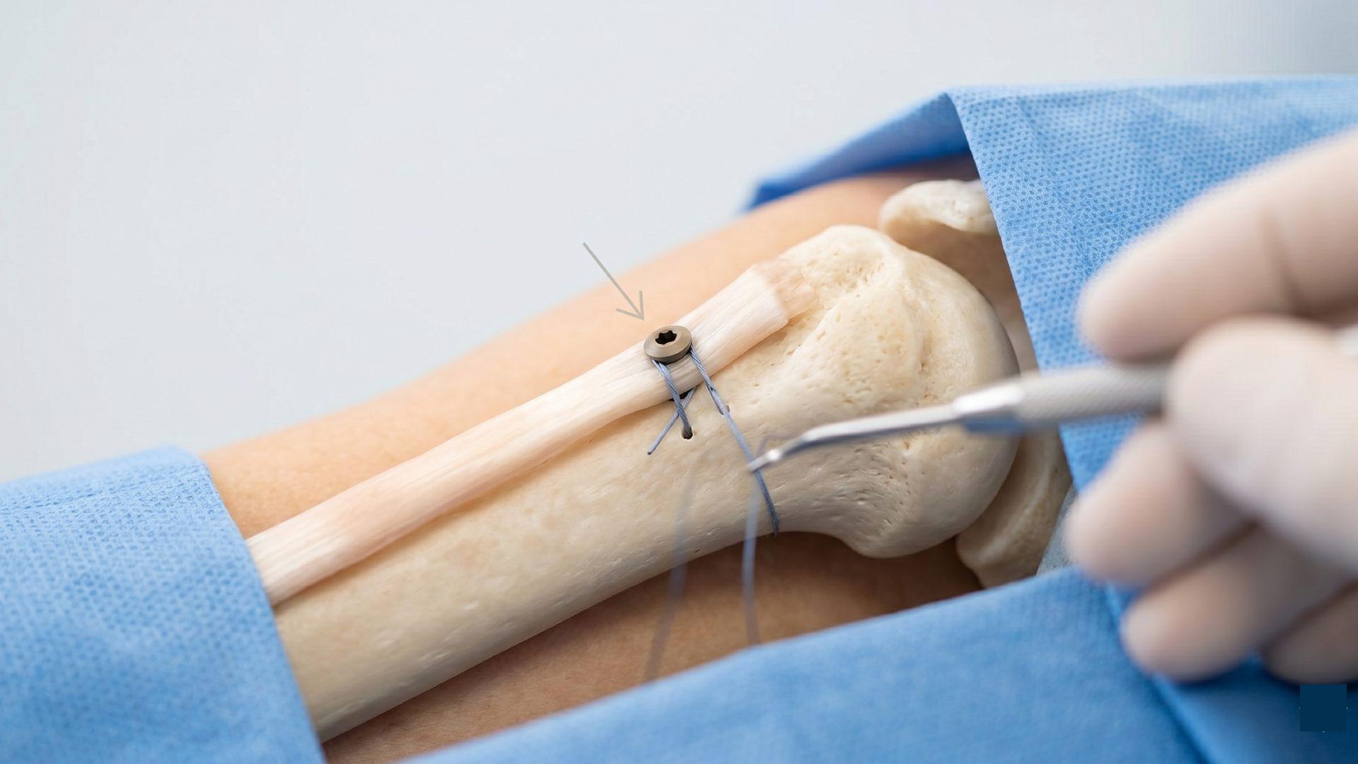 Biceps Tenodesis