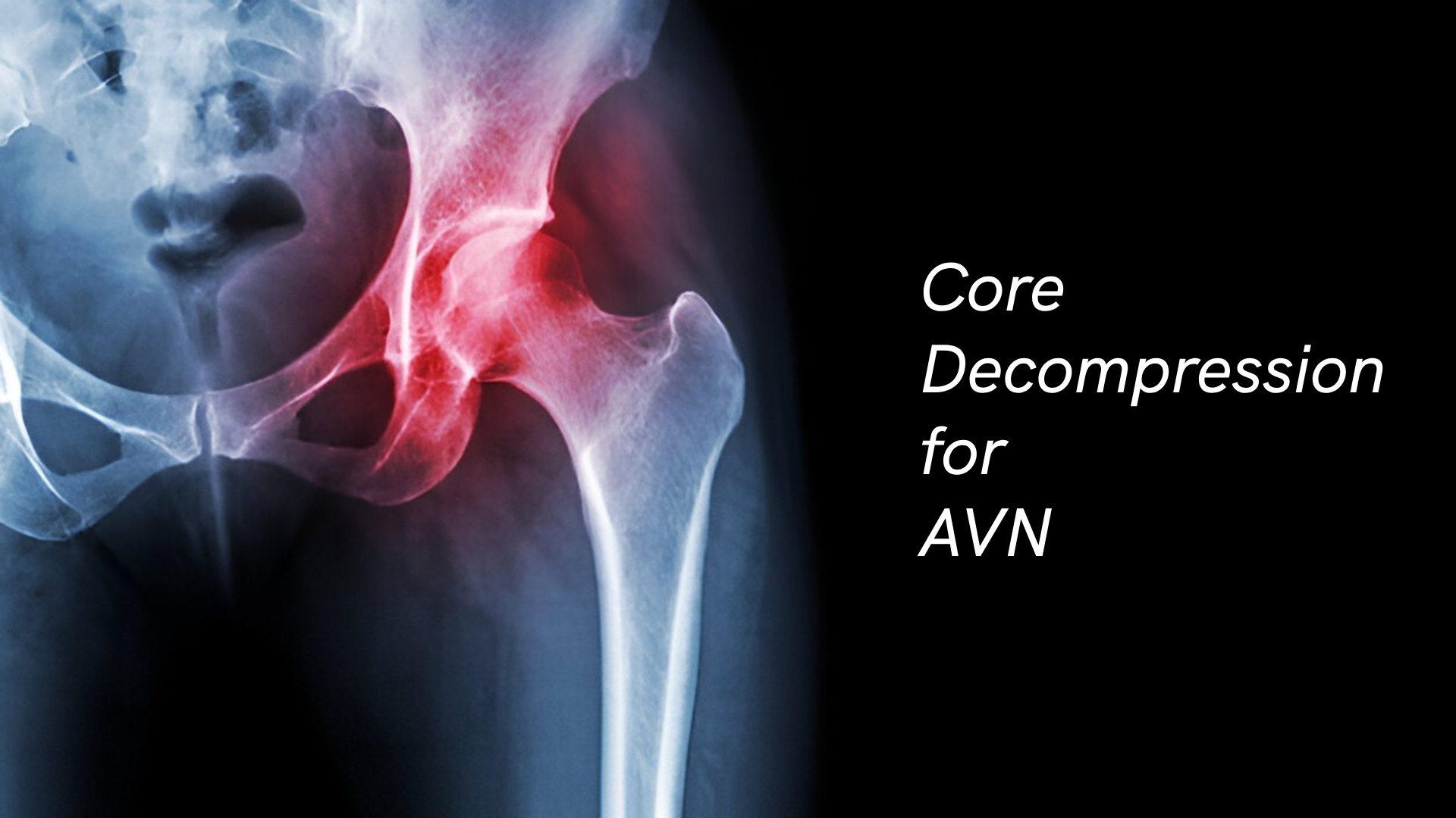 Core Decompression for AVN: Procedure, Recovery & Benefits