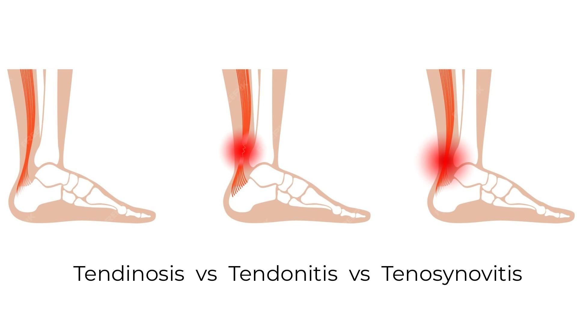 Tendinosis vs Tendonitis vs Tenosynovitis: A Complete Guide