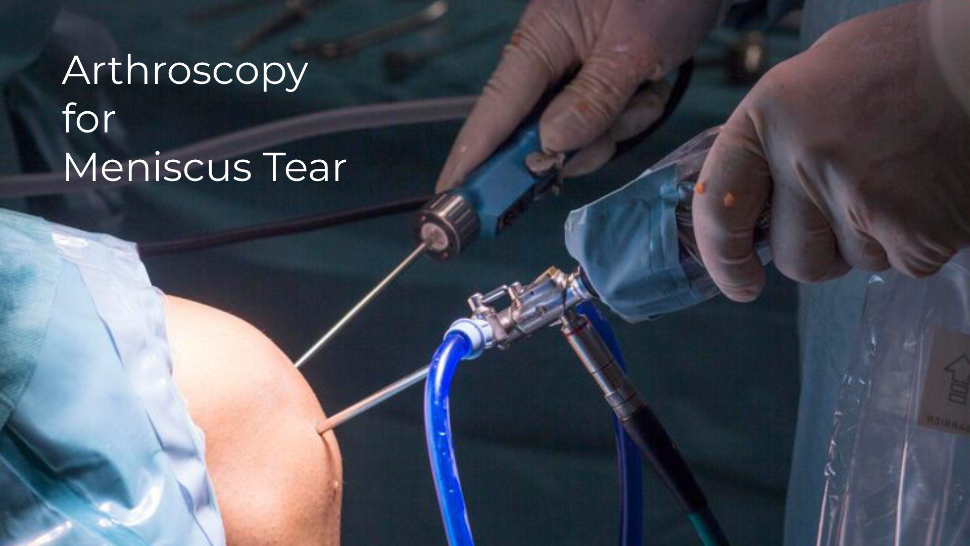 Arthroscopy for Meniscus Tear: Complete Surgery Guide