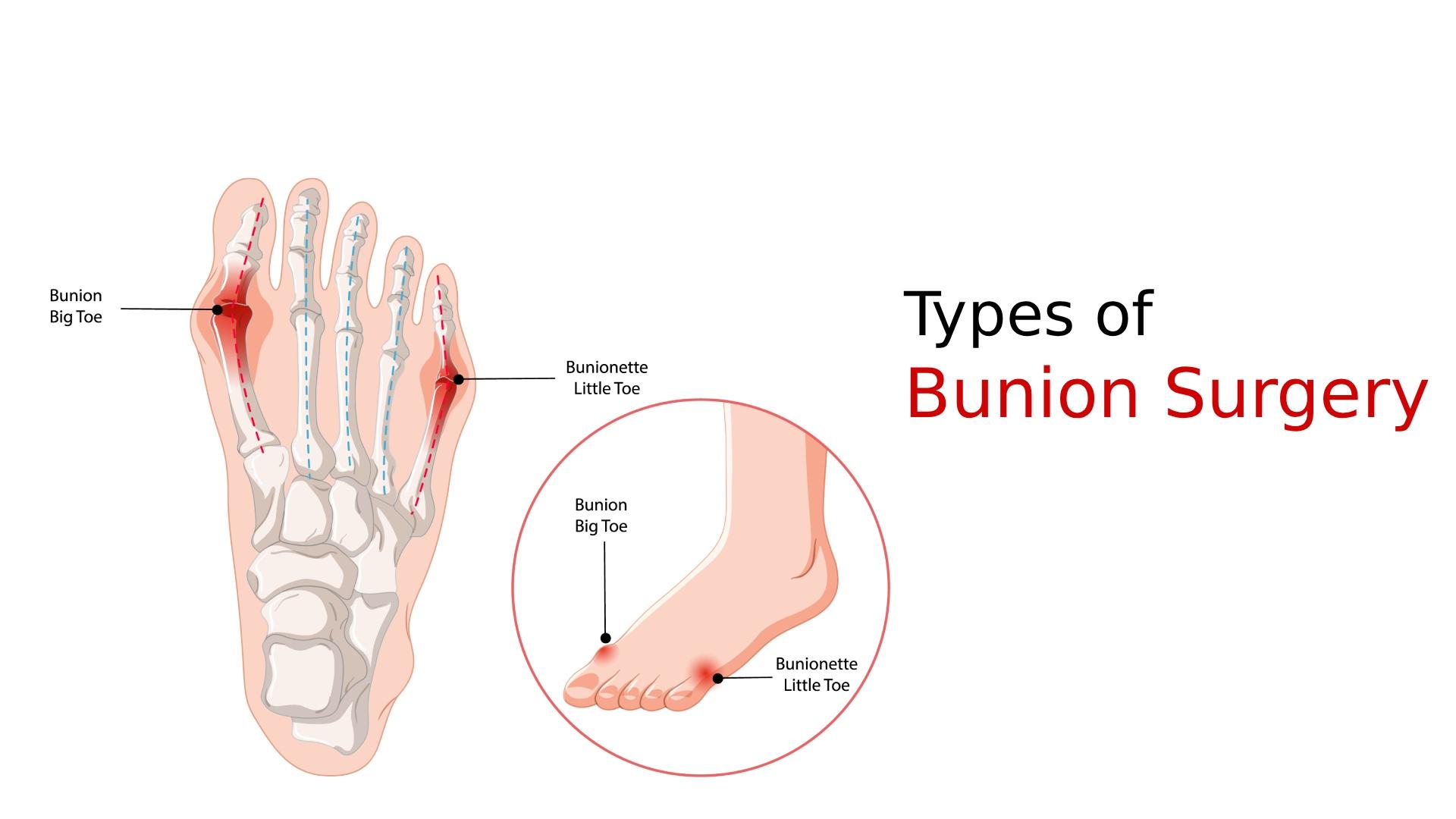 Bunion Surgery Types: When It’s Needed, Procedure & Recovery