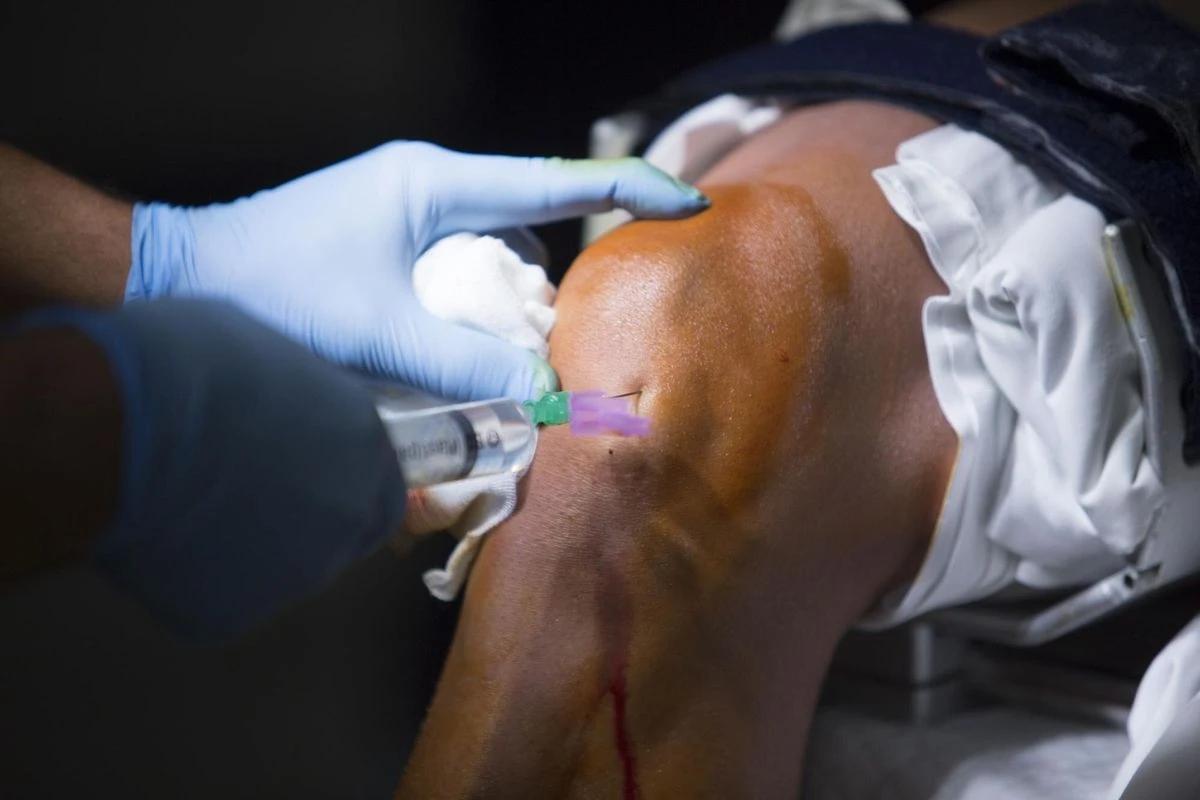 Stem Cell ACL Repair: Cutting-Edge Treatment Explained