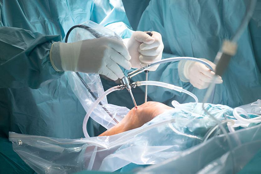 What is Arthroscopic Lateral Release? Procedure and Recovery Tips