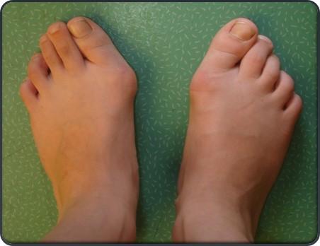 Hallux Valgus