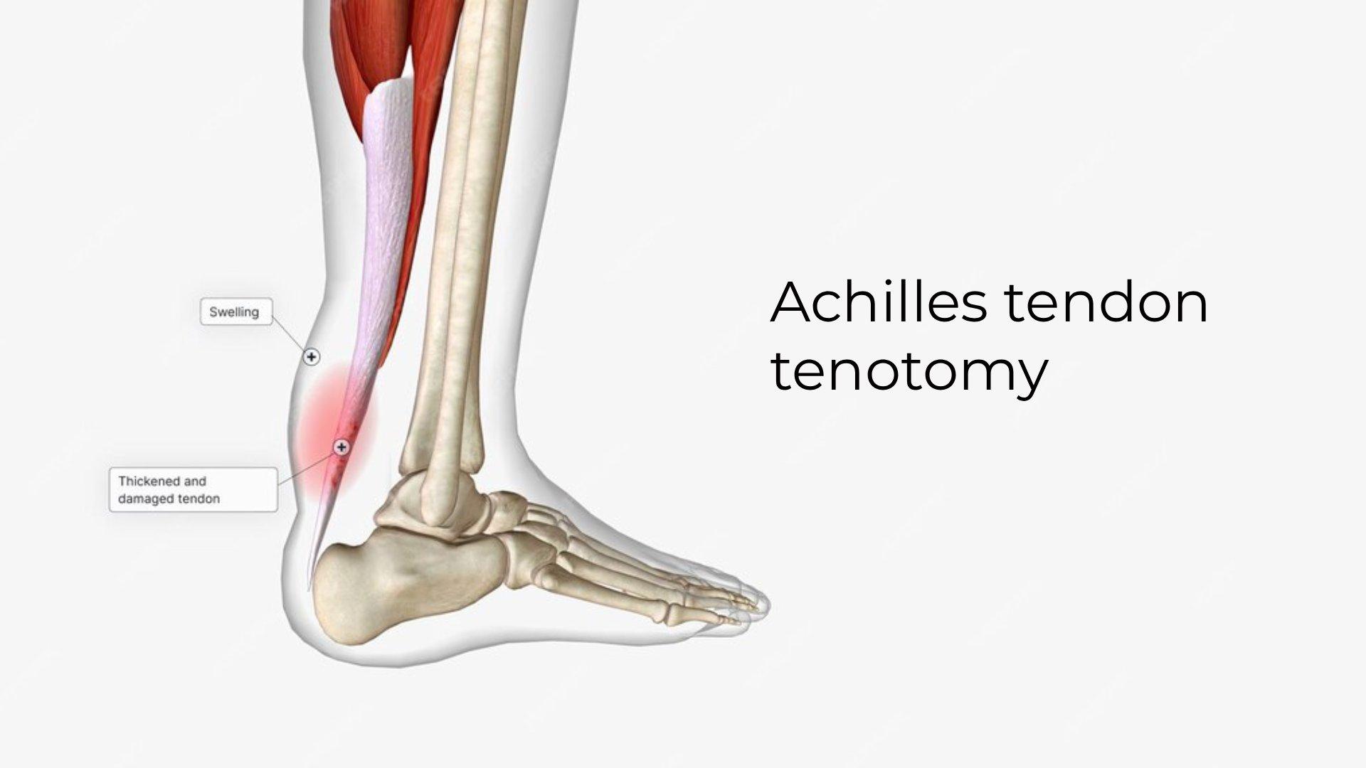 Achilles Tendon Tenotomy: Causes, Procedure & Recovery