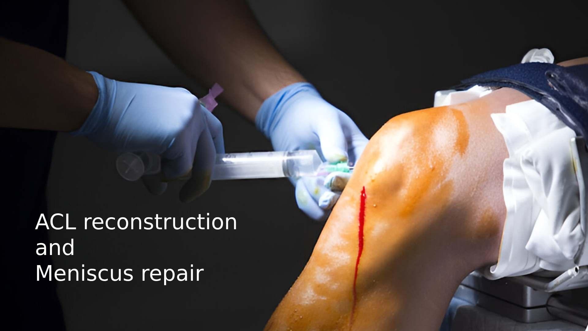 ACL Reconstruction and Meniscus Repair: The Ultimate Guide