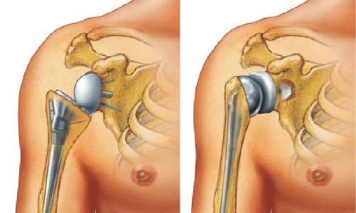 Shoulder Replacement Surgery