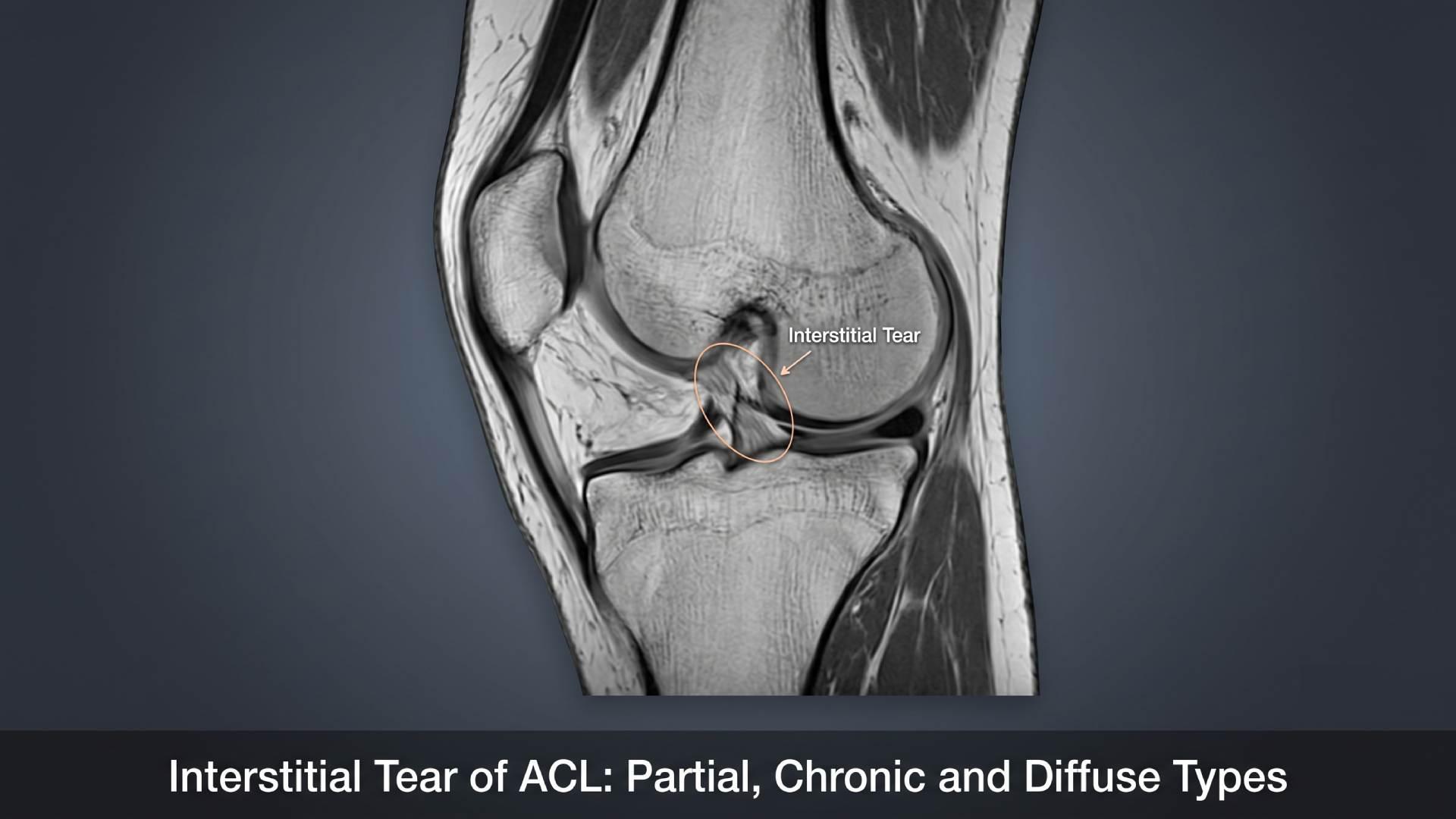 Interstitial Tear of ACL: Partial, Chronic and Diffuse Types Explained