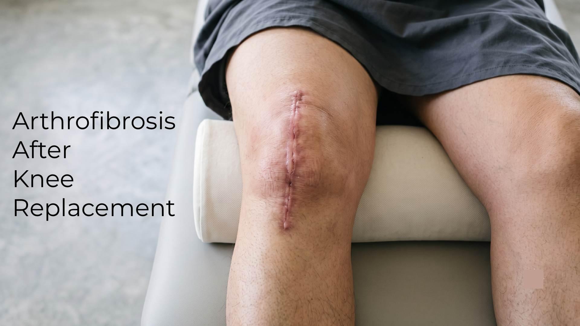 Arthrofibrosis After Knee Replacement: Causes & Treatment