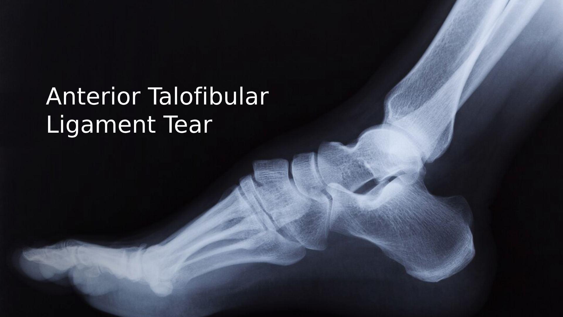 Anterior Talofibular Ligament Tear: Causes, Symptoms & Cure