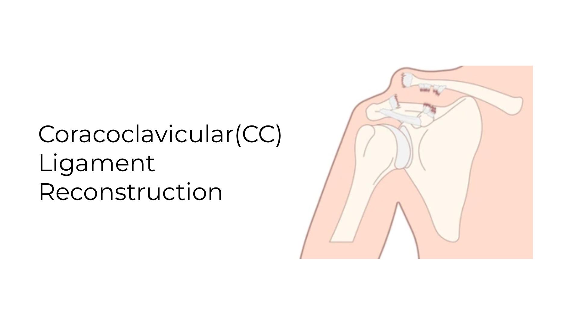 Coracoclavicular(CC) Ligament Reconstruction: Recovery Guide