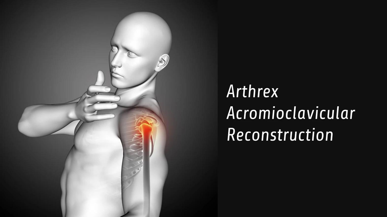 Arthrex Acromioclavicular Reconstruction Techniques: Quick Guide