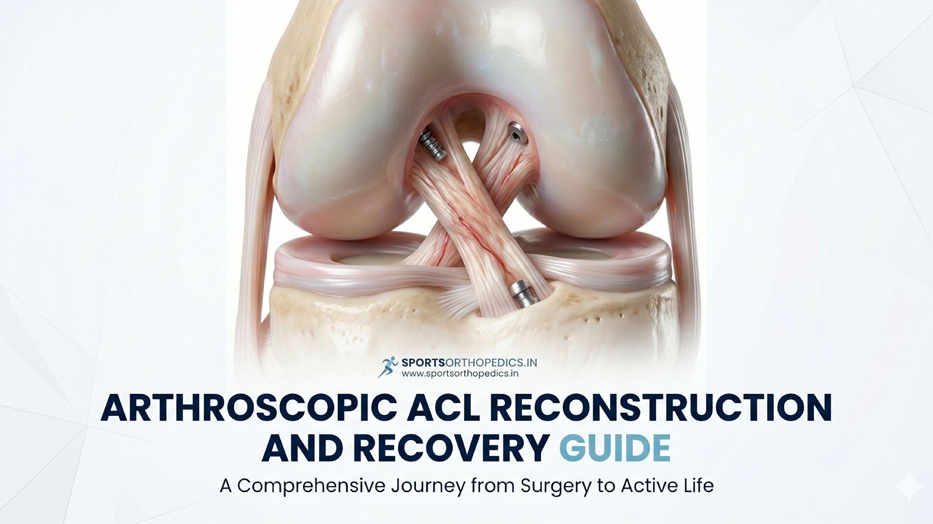 Arthroscopic ACL Reconstruction and Rehab Care Guide