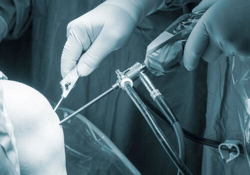 Arthroscopic Debridement Guide: Procedure and Recovery