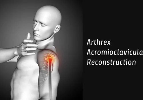 Arthrex Acromioclavicular Reconstruction Techniques: A Comprehensive Guide