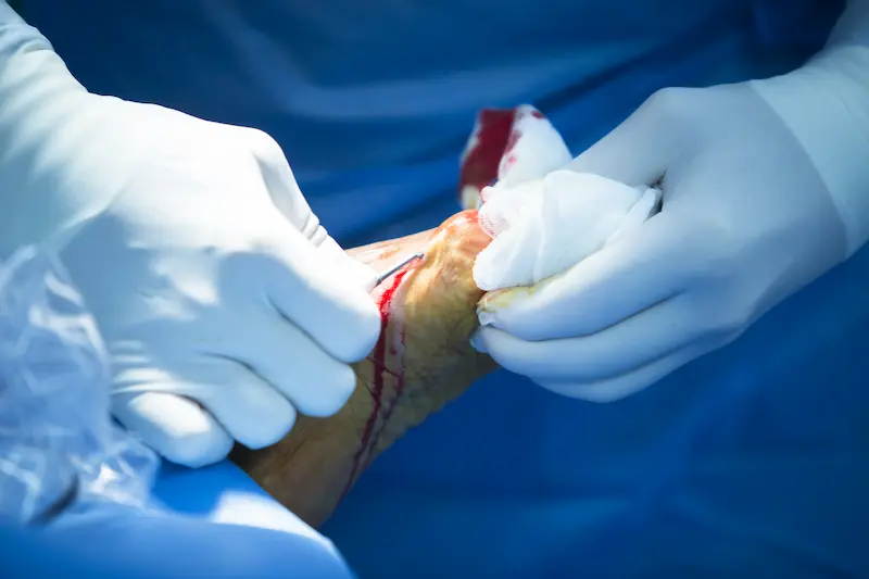 Meniscal Transplant Surgery