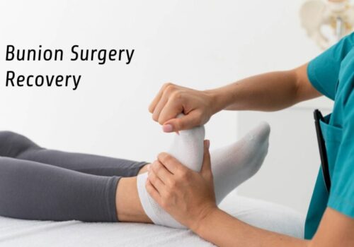 Bunion Surgery Recovery: Week by Week Guide