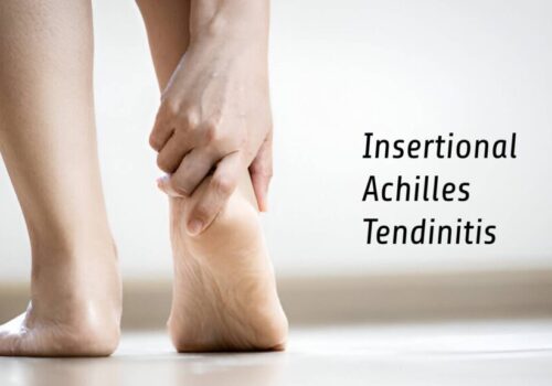 Insertional Achilles Tendinitis: Causes, Symptoms, and Cure