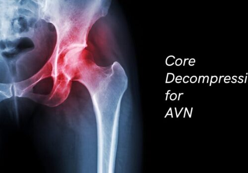 Core Decompression for AVN: Procedure, Recovery & Benefits