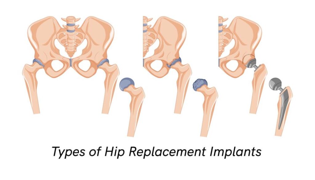 Types of Hip Replacement Implants