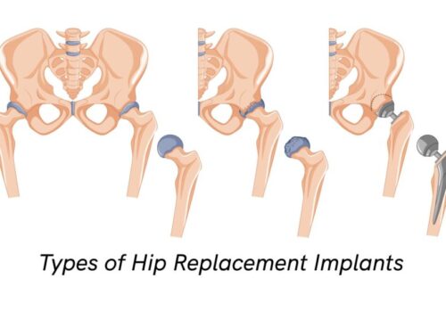 Types of Hip Replacement Implants: A Detailed Guide